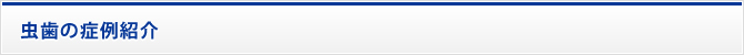 虫歯の症例紹介