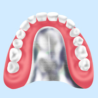 金属床義歯（総入れ歯・部分入れ歯）