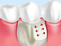 GTR（骨誘導再生）