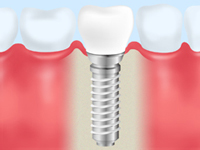 インプラント治療を受けた方