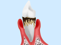 悪化した歯周病を放置すると……