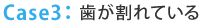 Case3：歯が割れている